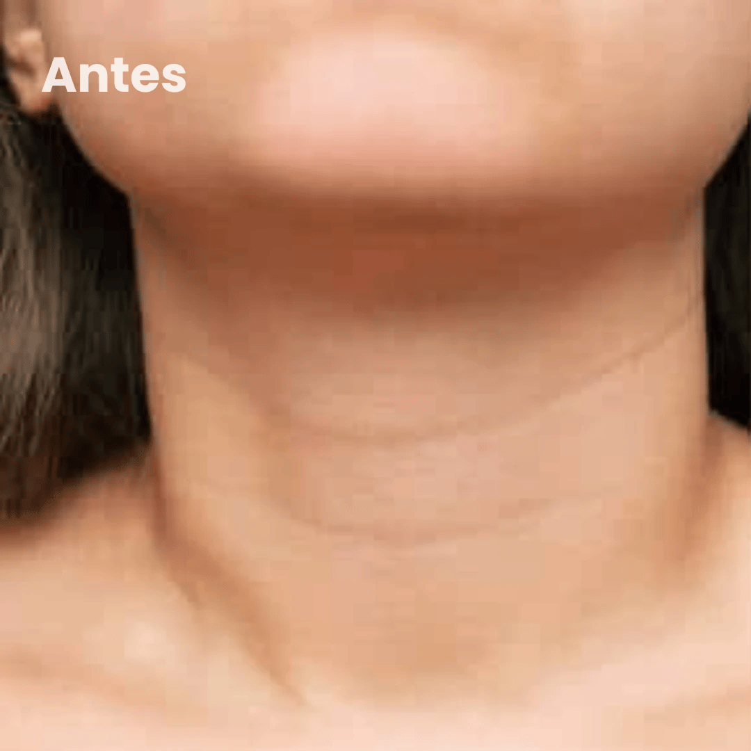 Rejuvenece lineas del Cuello