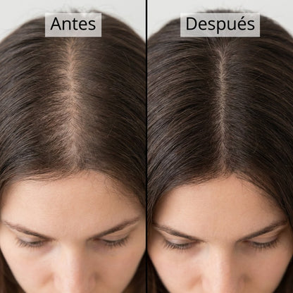 Sérum Capilar Elimina Entradas + Relleno de Zonas Despobladas